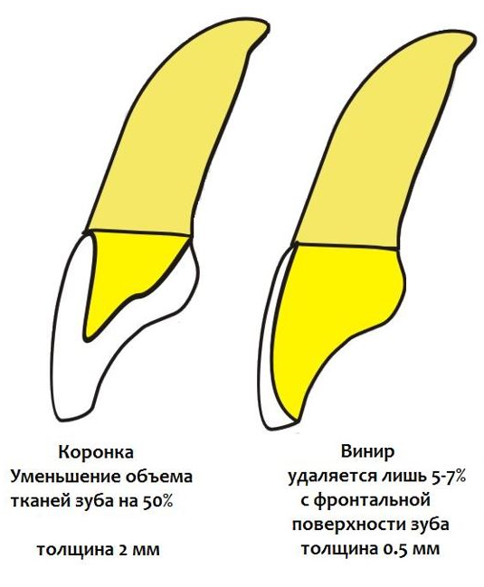 керамические виниры