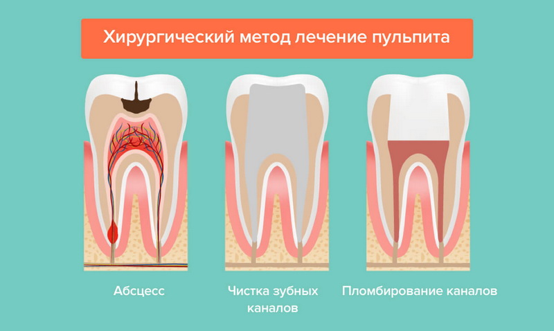 лечение пульпита