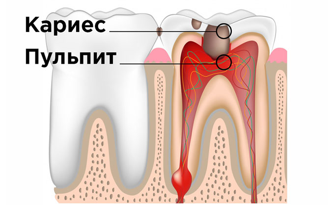 пульпит