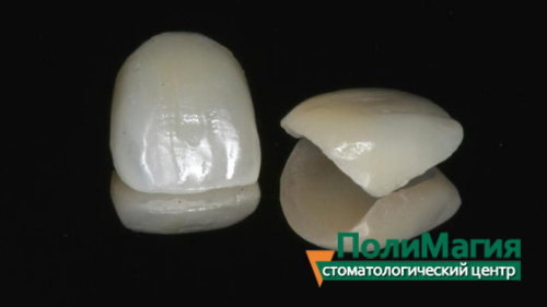 Фото виниров
